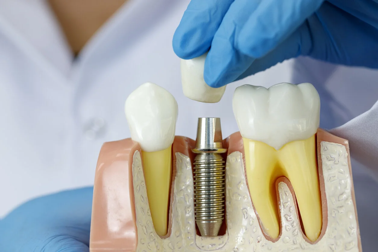 Dental Implants & Surgical Solutions